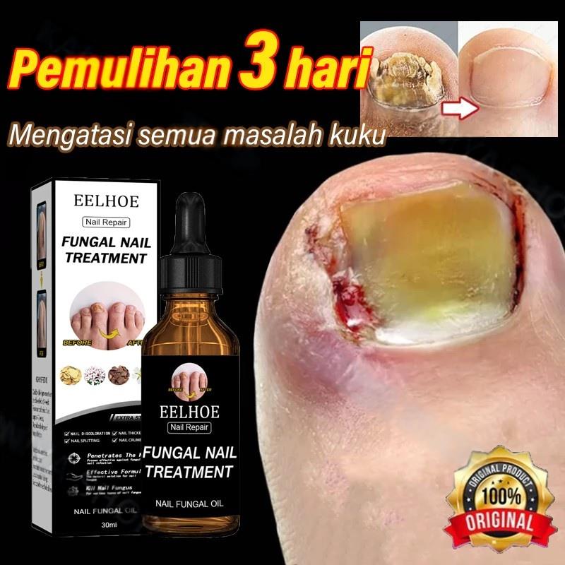 Obat Jamur Kuku Obat kuku jamur dan rusak Perawatan Kuku Berjamur Antibakteri Perawatan Kuku Onikomikosis Paronychia Anti Infeksi Kuku Toe Nail Pengobatan Jamur Minyak Nail Repair Essence Serum