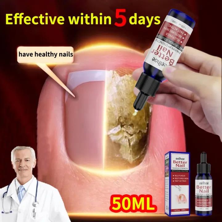 Obat Jamur Kuku Paling Ampuh Nail Repair Essence Serum Ajaib Viral Di Mengobati Kuku Berjamur Dan Rusak 50ML