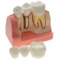 Dental Demonstration Study Teeth Model Implant Analysis Crown Bridge 4 Times
