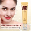 30g Scar Acne Mark Pimple Removal Remover Blemish Treatment Cream Ointment