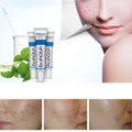 BIOAQUA Face care acne scar remove cream Moisturizing face cream
