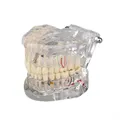 Transparent Disease Teeth Model with Dental Implant Bridge,Dental Model for Patient and Dental Student Education